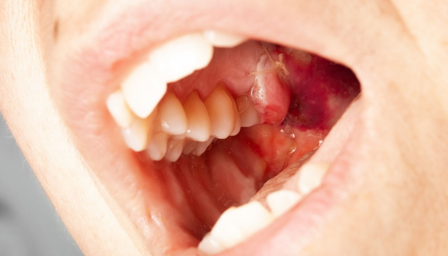 Blodig hevelse og blåmerke på innsiden av munnen ved siden av tennene. selvoppløsende sting lang tid ta kontakt såret sting stingene bruker uker sydd huden fjernes tråd dager bør tid fjerne litt fjernet kontakt mer kirurgen hos første lenge operasjonen gjør fikk operasjon ulike tar tråden sår dag saks kommer fleste flere type bandasje infeksjon tegn andre får høre tatt