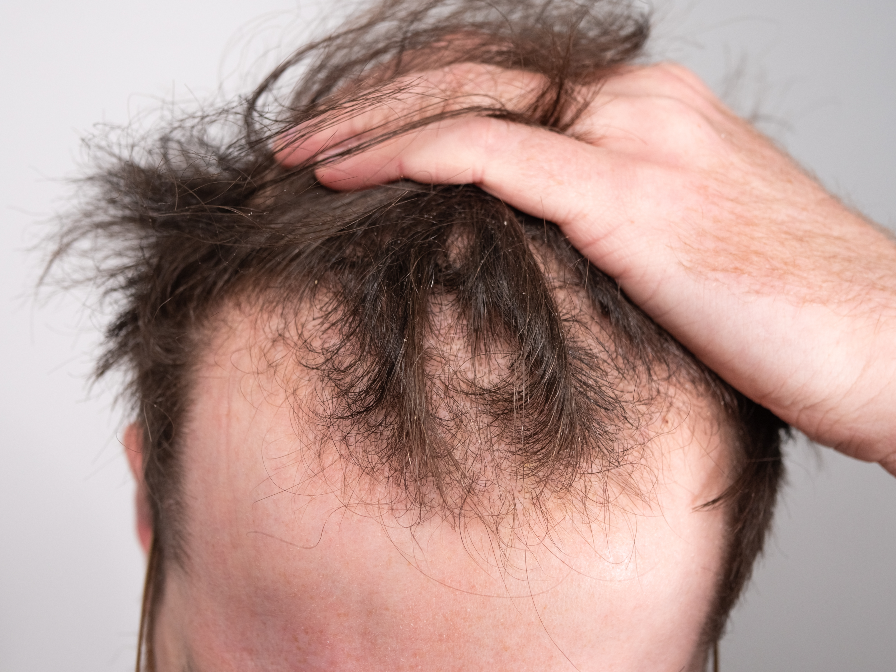 A man with a receding hairline and signs of male pattern baldness