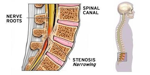 Picture of anatomy of the lumbar spine with stenosis narrowing by bony change