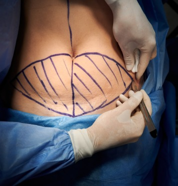 An image of a patient undergoing mini abdominoplastia procedure to remove excess skin and fat from the lower abdomen.