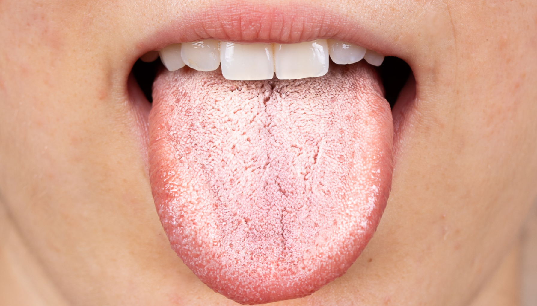 Hvitt belegg på tunga ved forkjølelse: Ufarlig, men verdt å følge med på 9 Tunge med lys belegning og tørr overflate som kan tyde på dehydrering eller bakterieoppbygging i munnen.