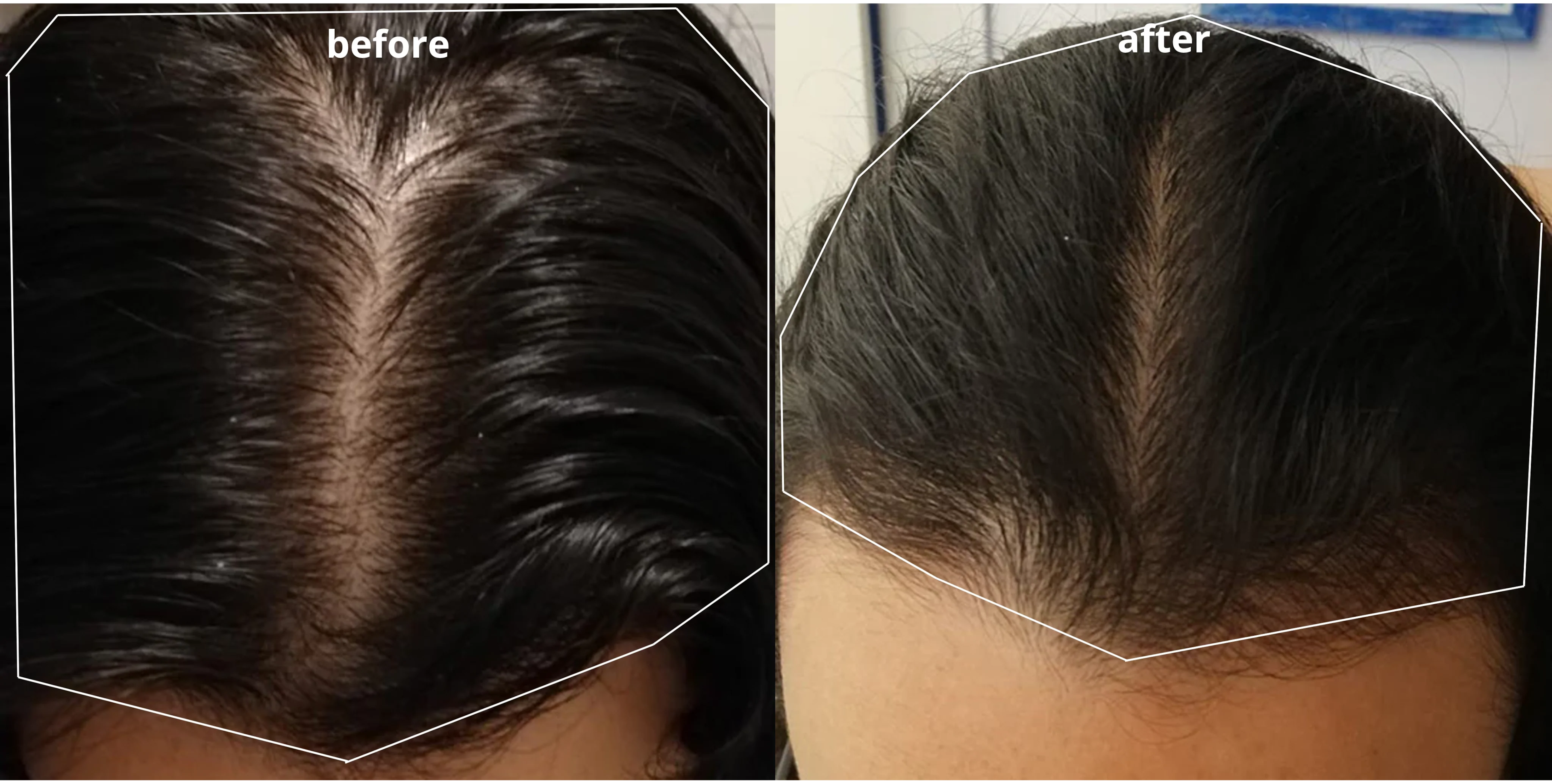 julia scalp before and after best hair loss treatment for female ireland