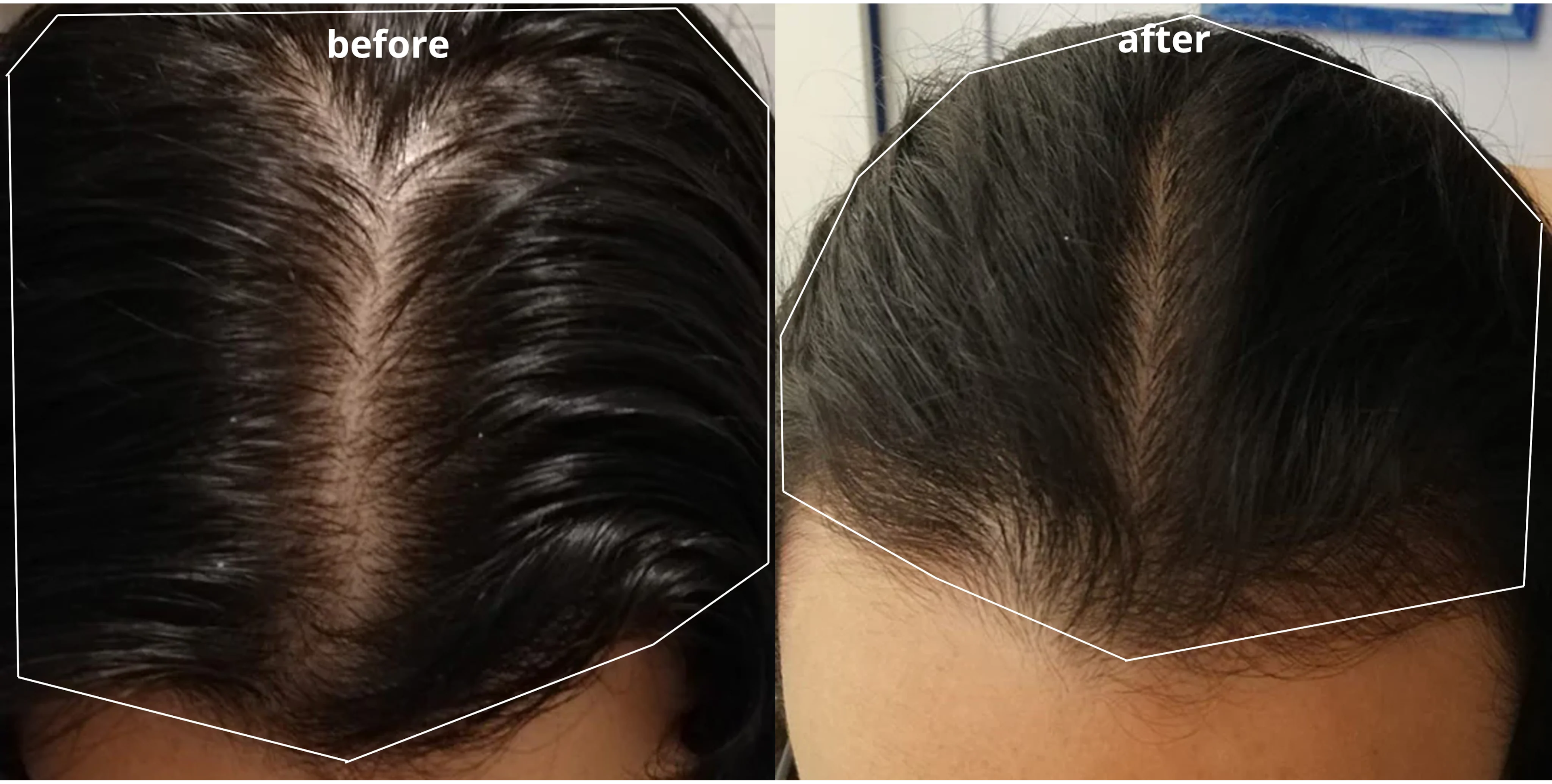 Hair loss treatment on sale for women