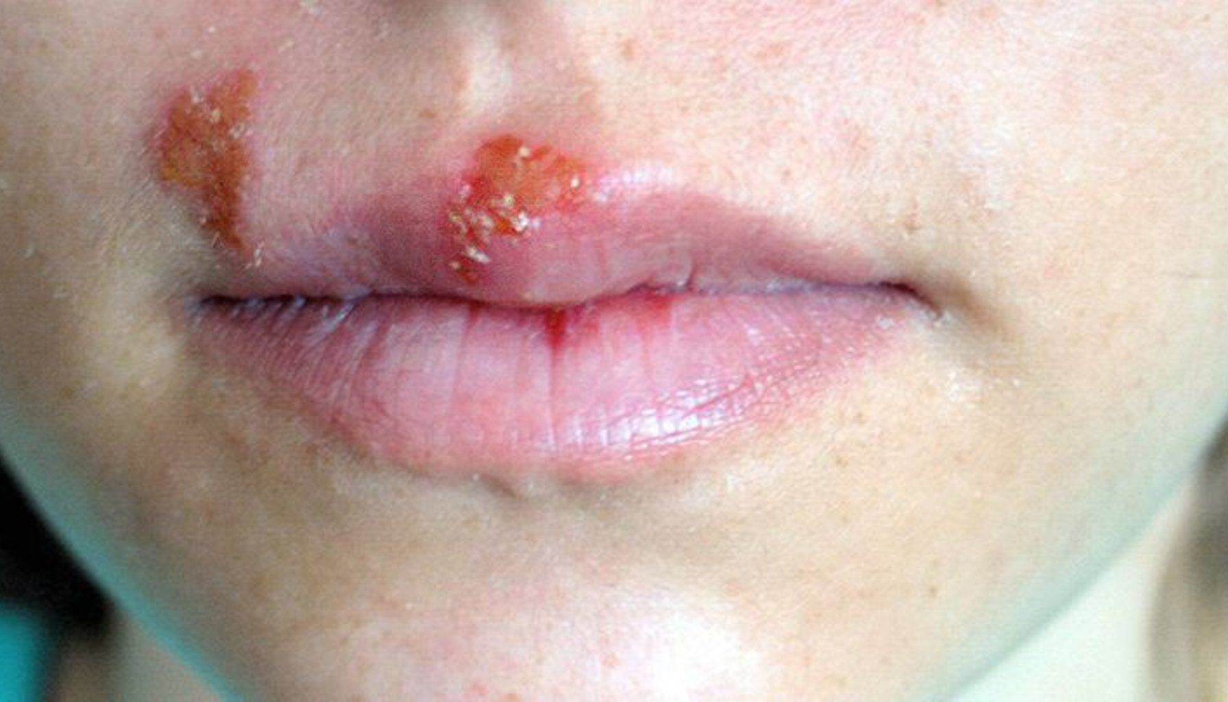 Herpes i munnen den vanlige men ofte misforståtte infeksjonen 6 Person med sprukne og skorpebelagte munnsår på overleppen, viser tydelige tegn på herpesutbrudd eller infeksjon