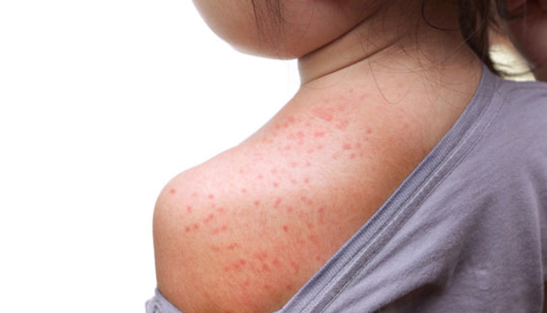 Barn med rødt utslett og prikker på skulder og rygg under huden.