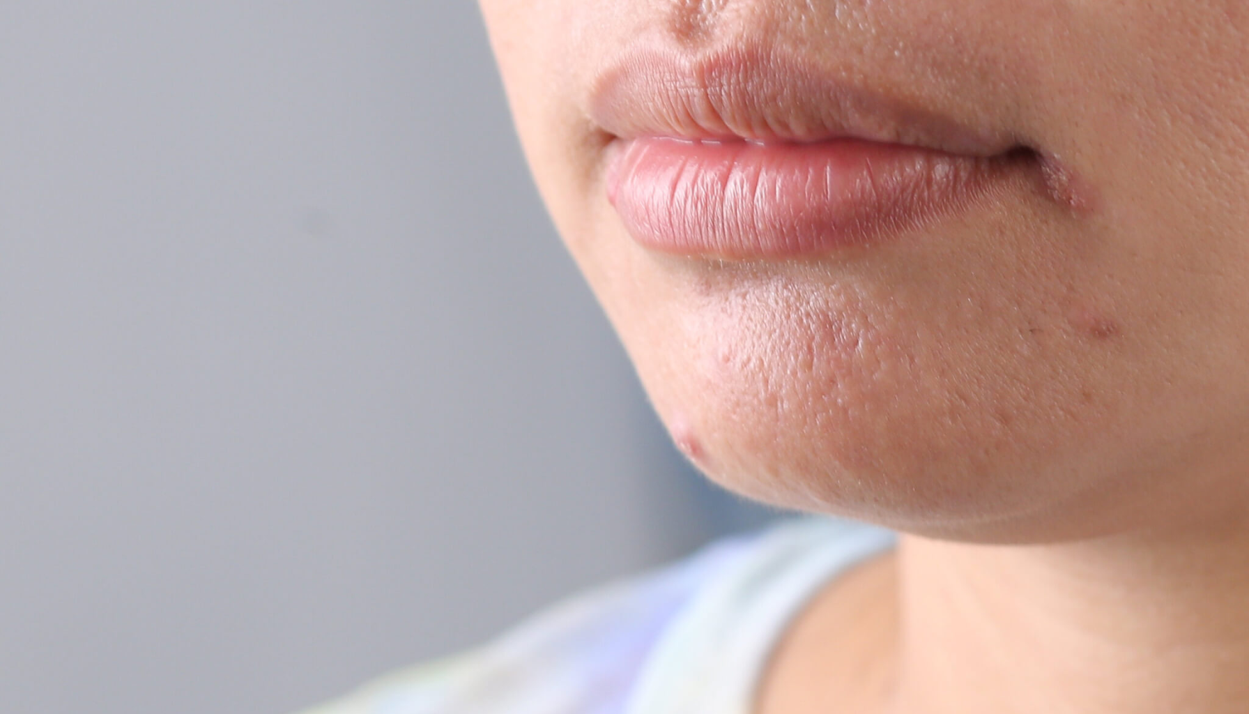 Nærbilde av munn og hake med små utslett og irritasjon rundt munnen, mulig tegn på perioral dermatitt.