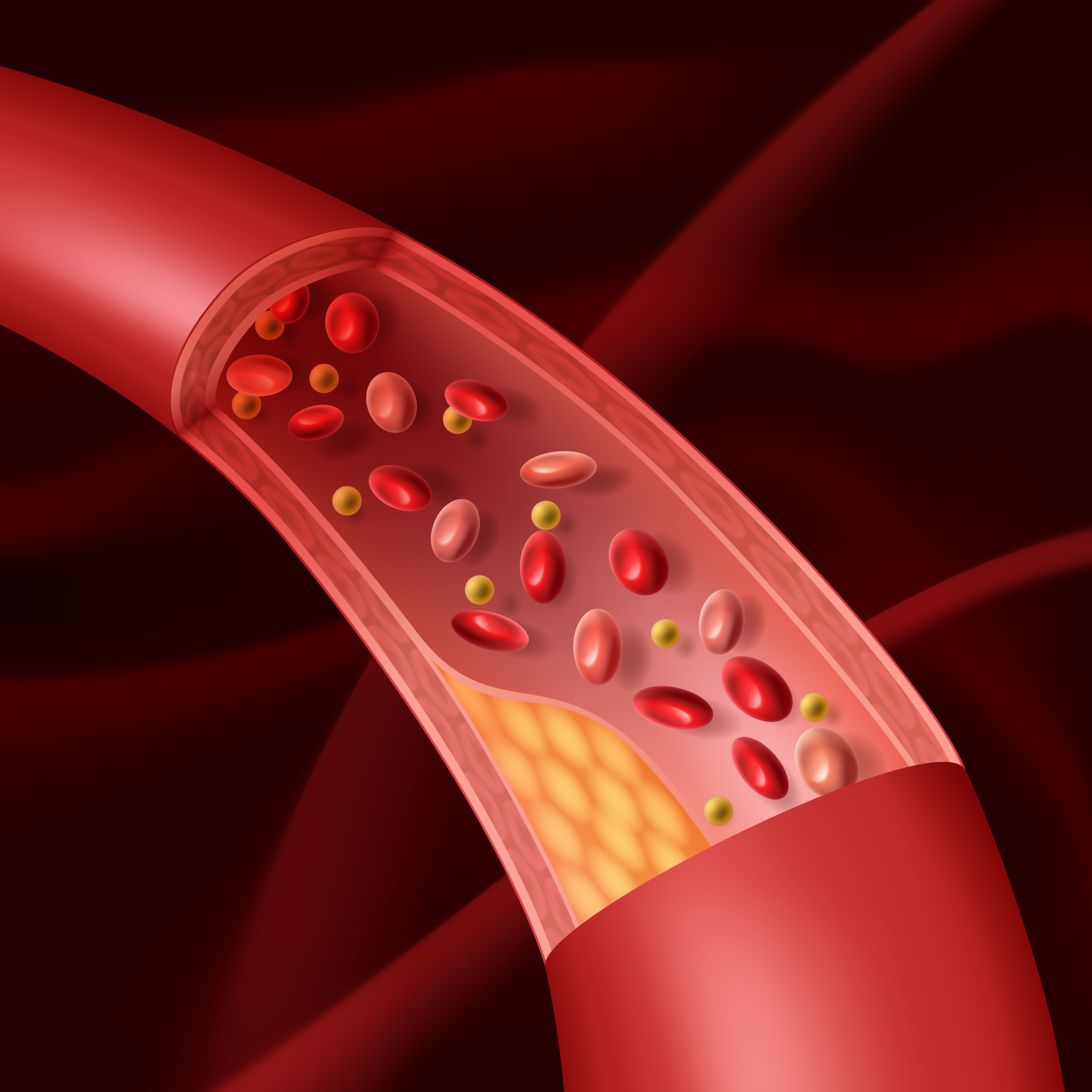 The cholesterol will accumulate in the blood vessels to produce plaques.