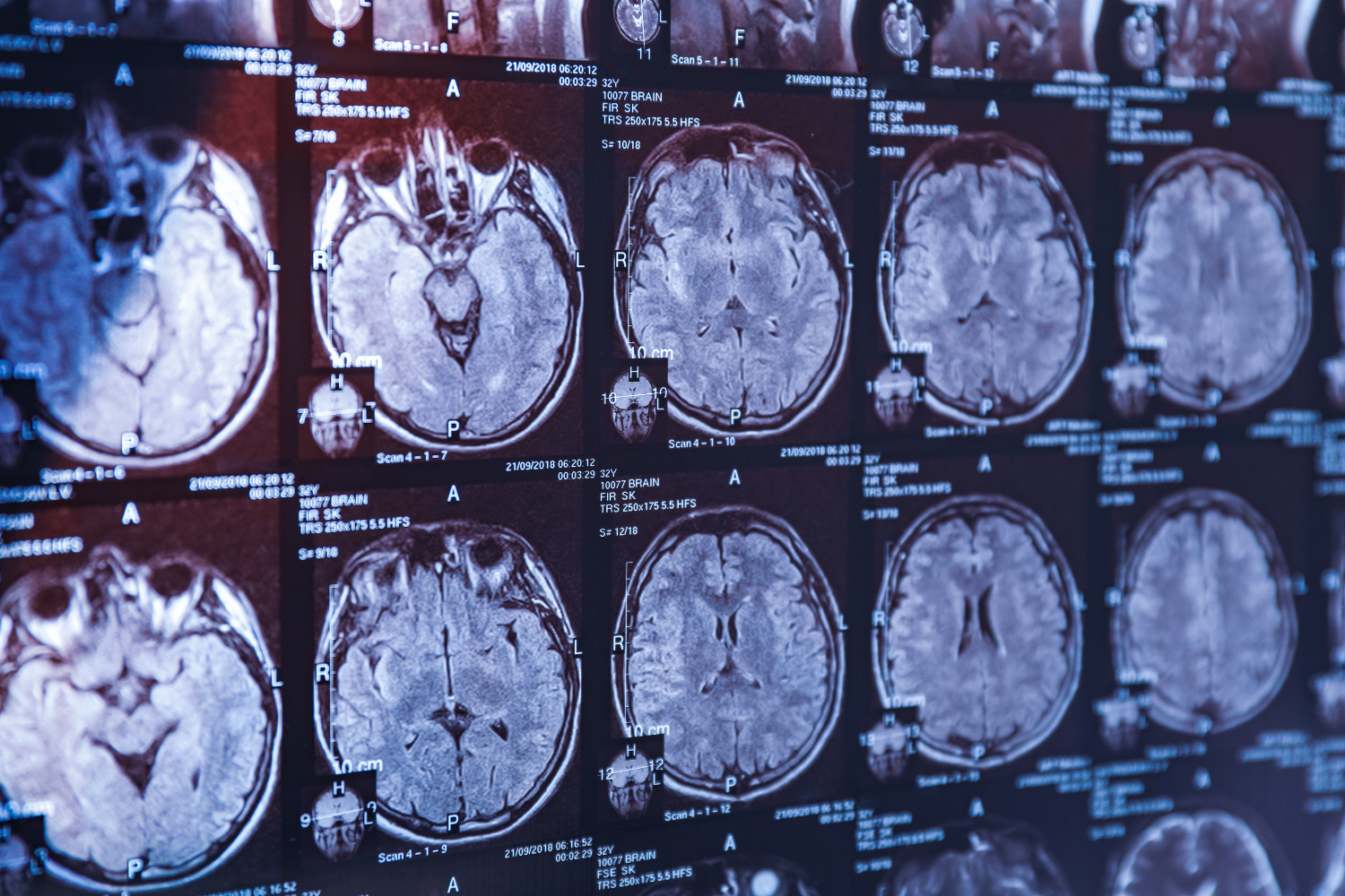 CT scan of a brain.