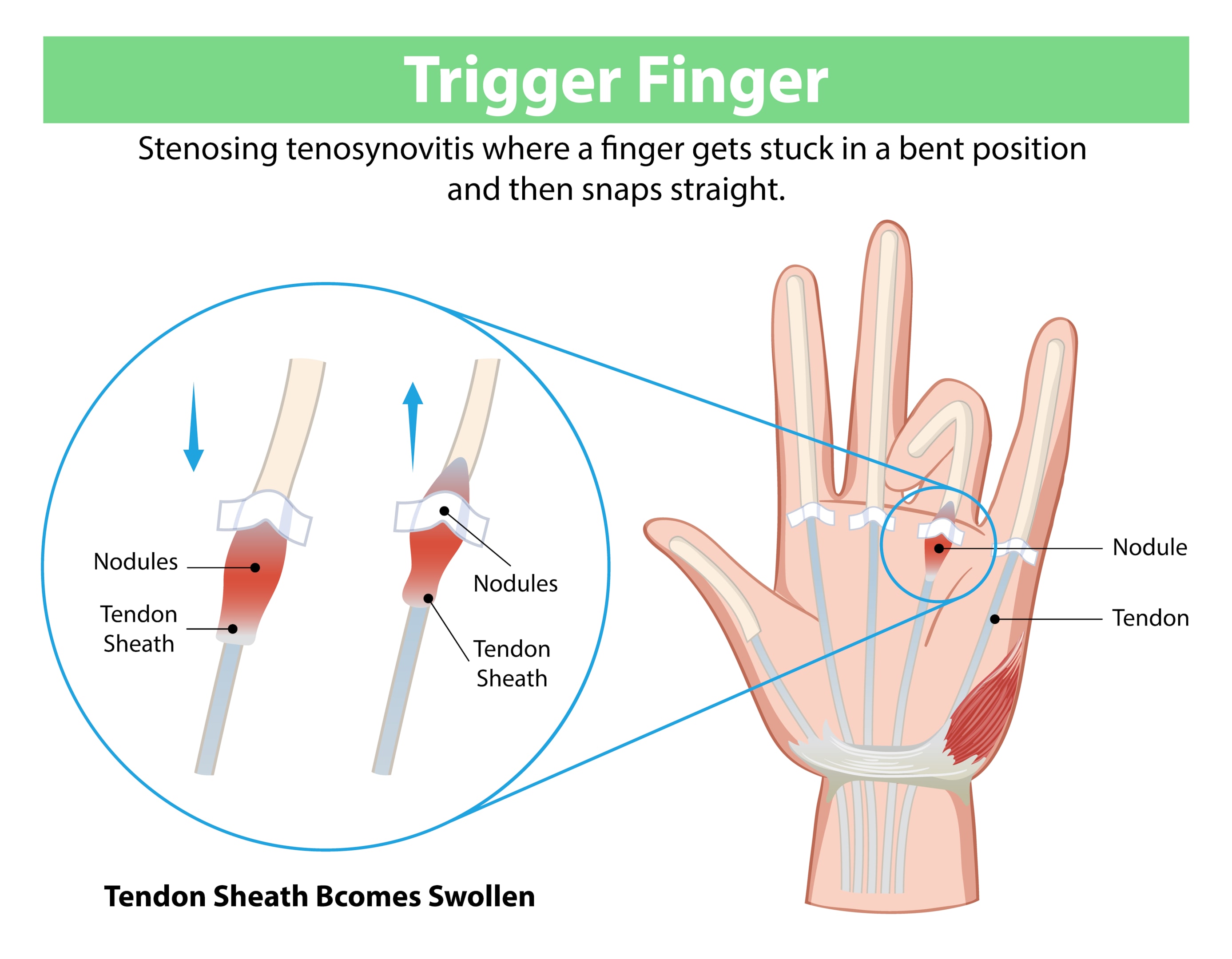 Diagram explaining trigger finger, showing swollen tendon sheath, nodules, and how the finger becomes stuck before snapping straight.