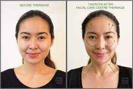 Facial Care Centre Thermage Review + Before and After Photos | Lush Angel