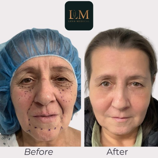 A doctor performing a fat transfer procedure combined with lower blepharoplasty