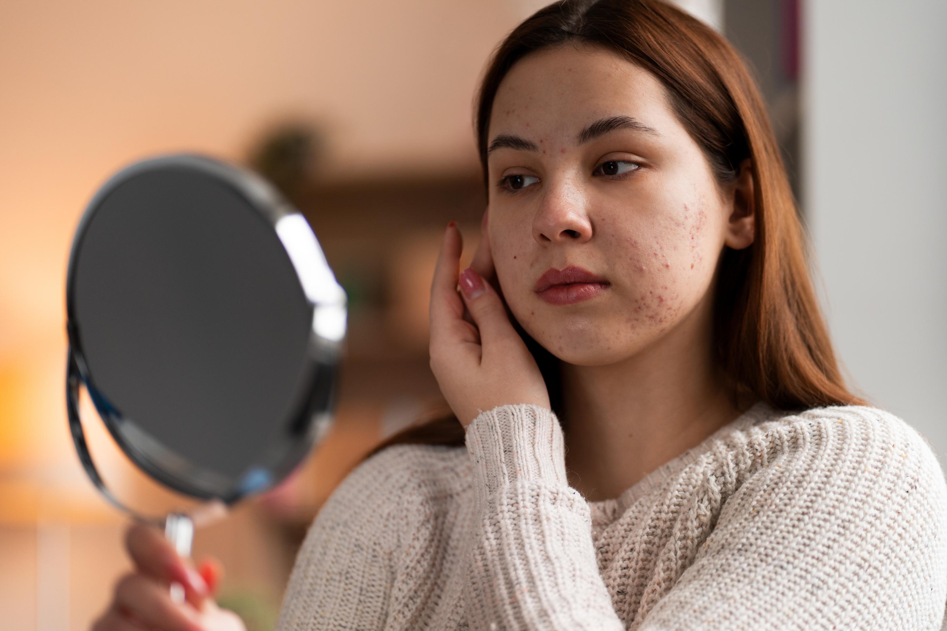 woman with acne touching her face