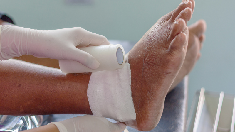 Neben Medikamenten, die zur Behandlung von Gicht eingesetzt werden, kann man auch kühlen