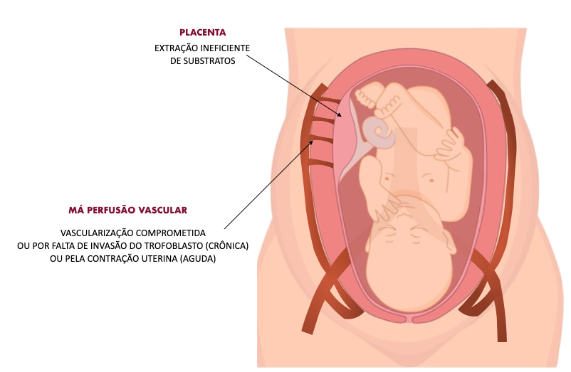 Sofrimento fetal, o que é e o que fazer? | Fetalmed