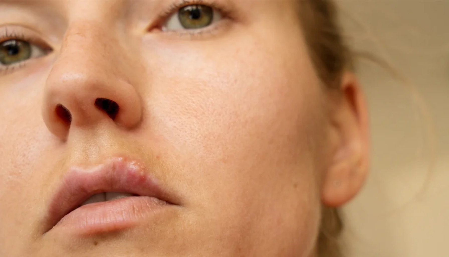 Nærbilde av lepper med begynnende munnsår (herpes) på overleppen.