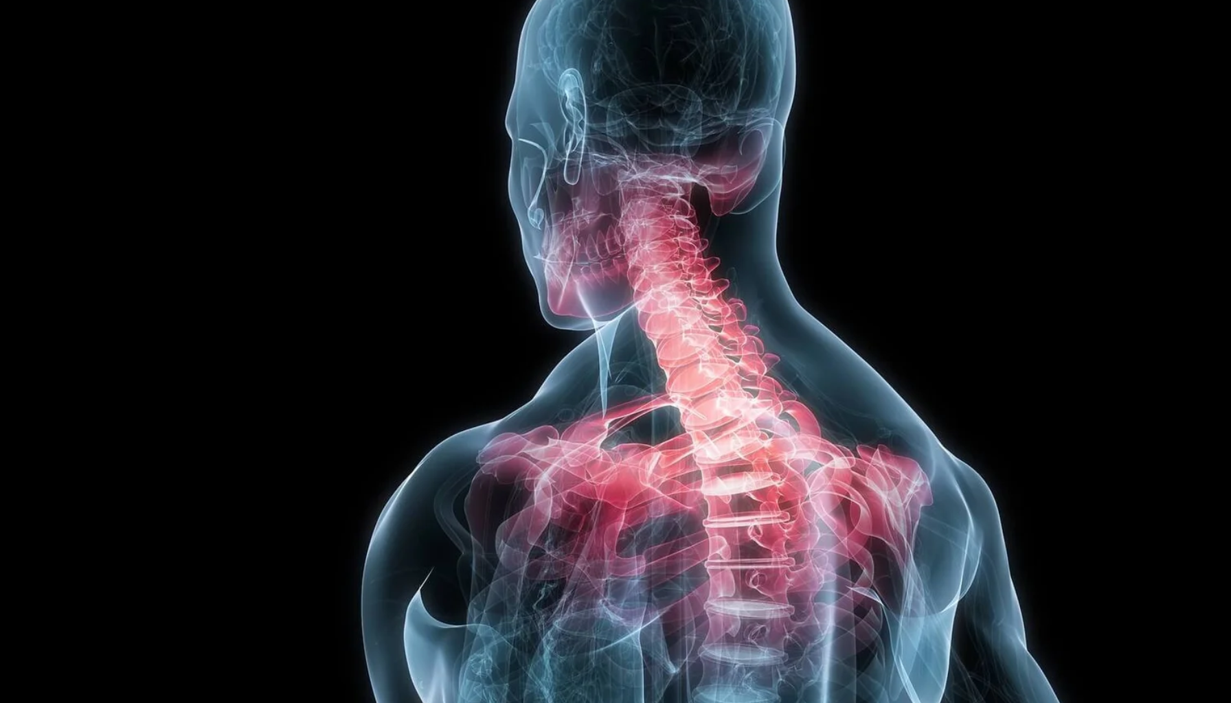 Illustrasjon av menneskekropp som viser nakke og øvre rygg med markert rød betent smerteområde i det visuelle.