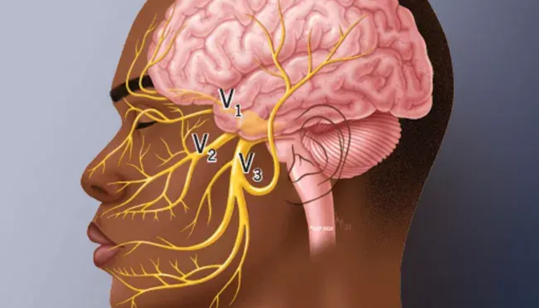 Illustrasjon som viser trigeminusnervens tre grener i ansikt og hjerne med tydelig markerte nervebaner på diagrammet her. trigeminusnevralgi forekomsten øker med alderen hyppigere hos kvinner personer over 50 år mikrovaskulær dekompresjon øker med alderen ansiktet med et skjerf sterke smerter multippel sklerose utelukke andre intense skarpe ansiktets følenerve smertefull tilstand utløsende faktorer ansiktet behandling nerven symptomer andre hos smertene årsaker trigeminusnerven smerter tilstanden anfall ofte effekt viktig symptomene smerte intense smerteanfall vanligvis tilfeller sterke anfallene oftest under tilstand flere finnes pasienter får tre mer informasjon utløses ansiktssmerter smerten oppstår tillegg skarpe deler svært inngrep smertefull mest annen medisiner bivirkninger trigeminus behandlingen perioder sjelden minutter unngå utløsende bruker menn sekunder komme berøring varer forårsaker behandlinger smertefulle lynende per bør alternativ