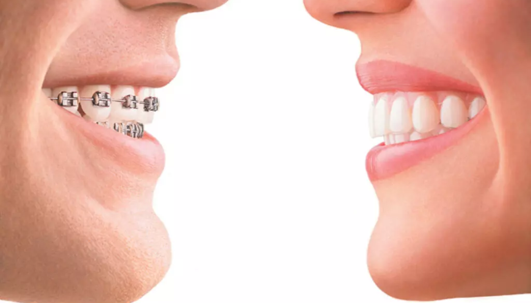 Profil av to smilende personer, én med regulering og én med rette tenner, som illustrerer tannregulering før og etter behandling.