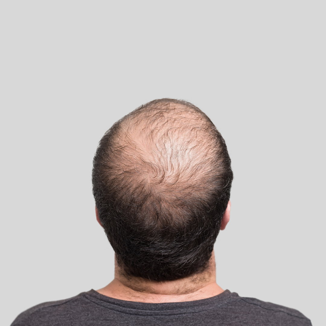 Testosterone and hair loss