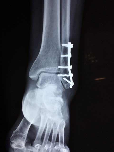 ankle, fracture, foot