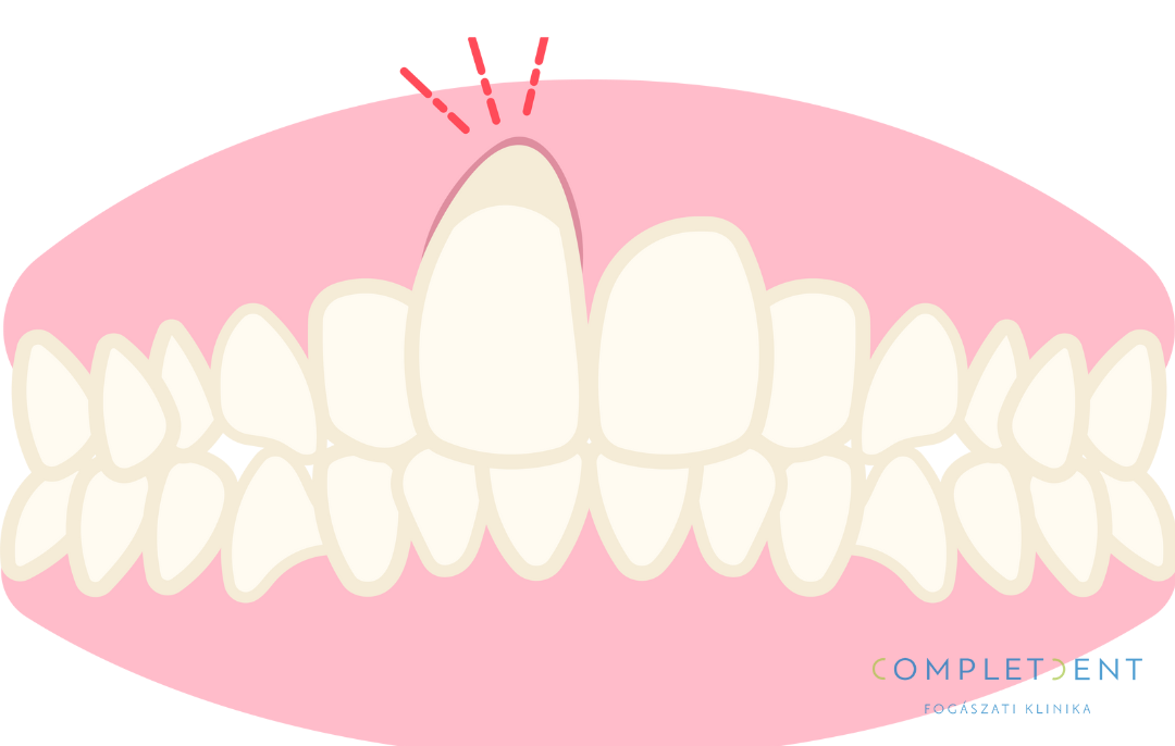 A fogat tartó íny visszahúzódása és az íny alatti terület szabaddá válása súlyos problémákkal járhat. 