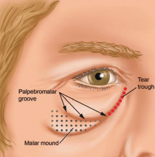 Tear trough deformities and under-eye concerns