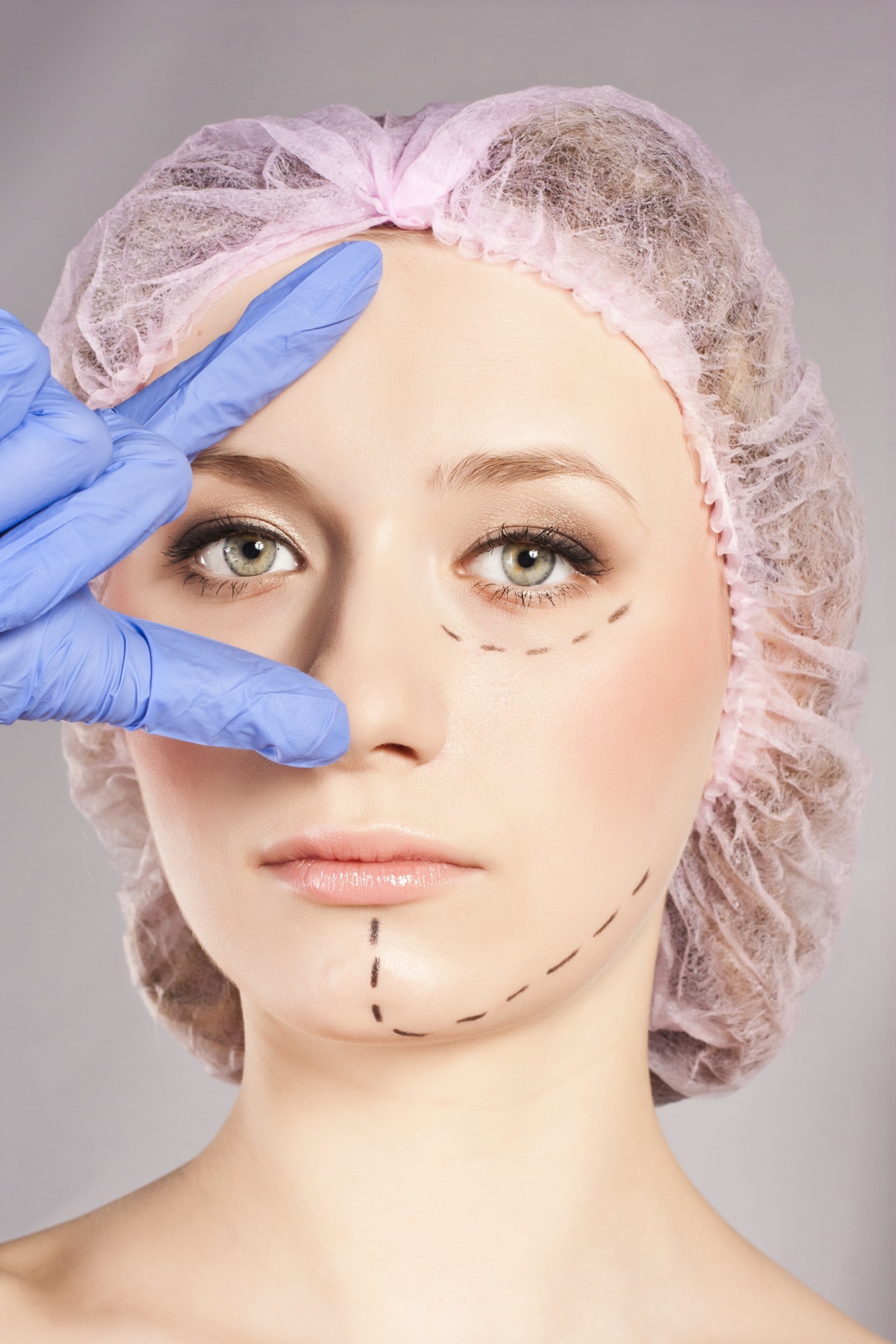 A woman about to undergo cosmetic surgery with a hairnet and facial markers