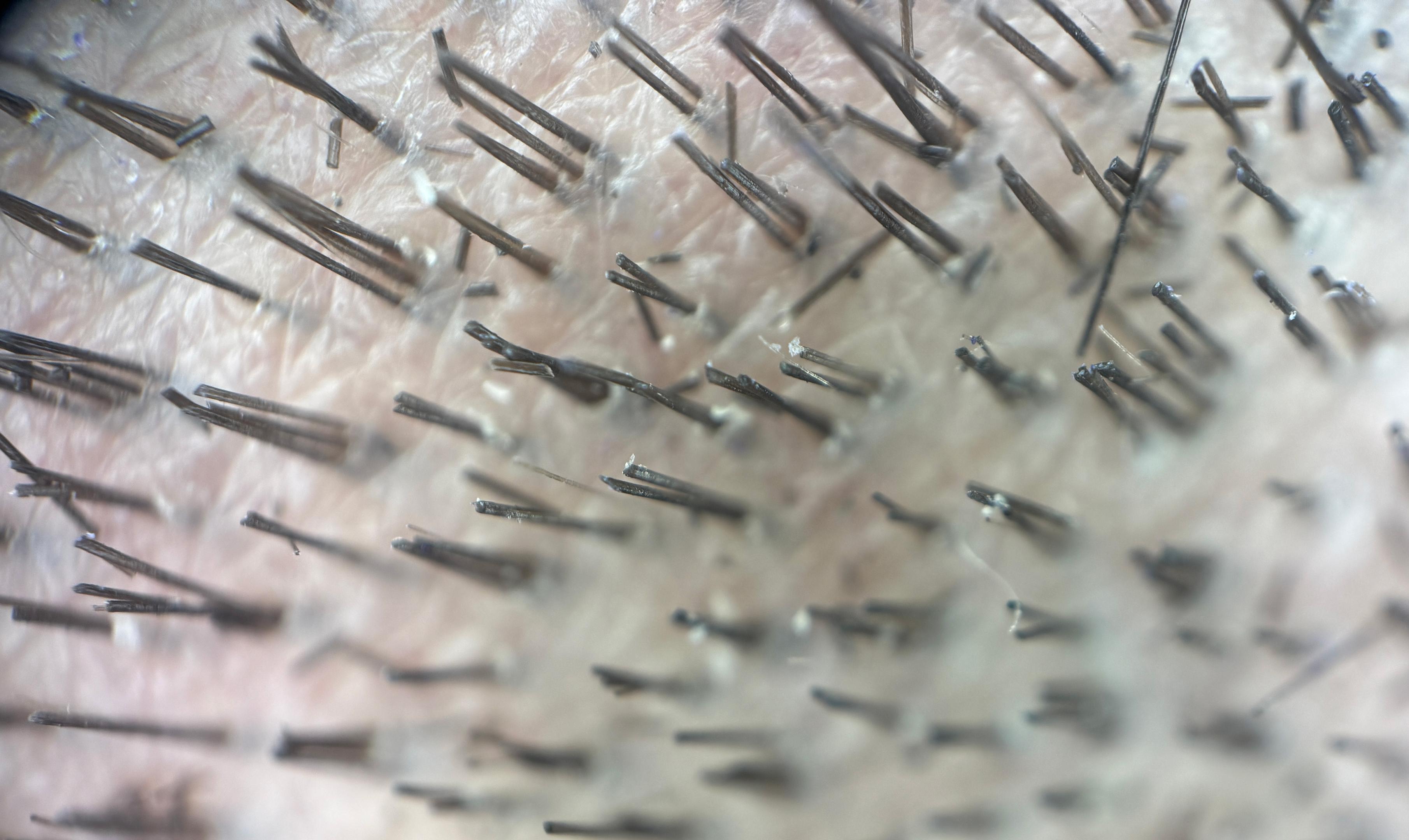 Dr Kunnure Clinic- Hair Transplant - Good donor density