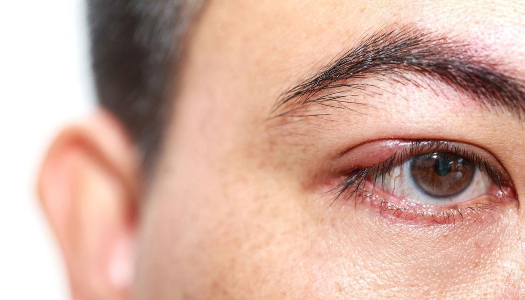 Nærbilde av øye med hovent øyelokk som viser tegn på irritasjon eller infeksjon."