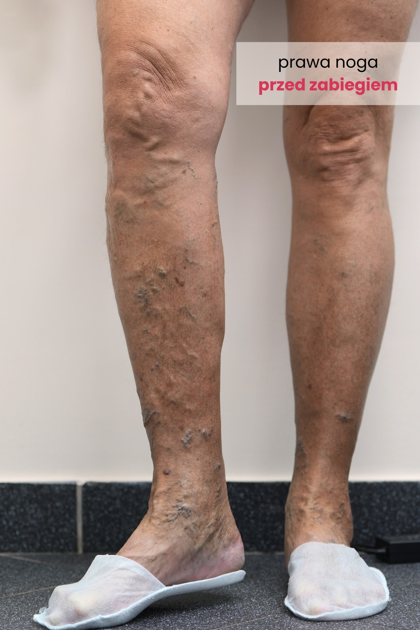 Zdjęcie prawej nogi Pacjenta przed zabiegiem skleroterapii