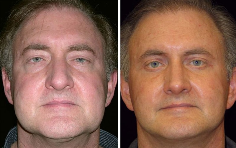 A patient of Dr. Delgado 6 monthe after a deep plane facelift, and upper and lower eyelid lift and buccal fat pad reduction.