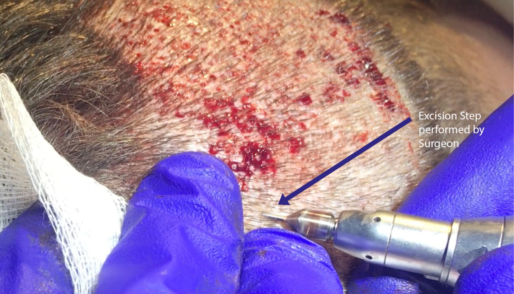 Dr Vikas Kunnure - Excision of Grafts in FUE in donor area by Dr Kunnure