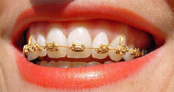 gold braces 