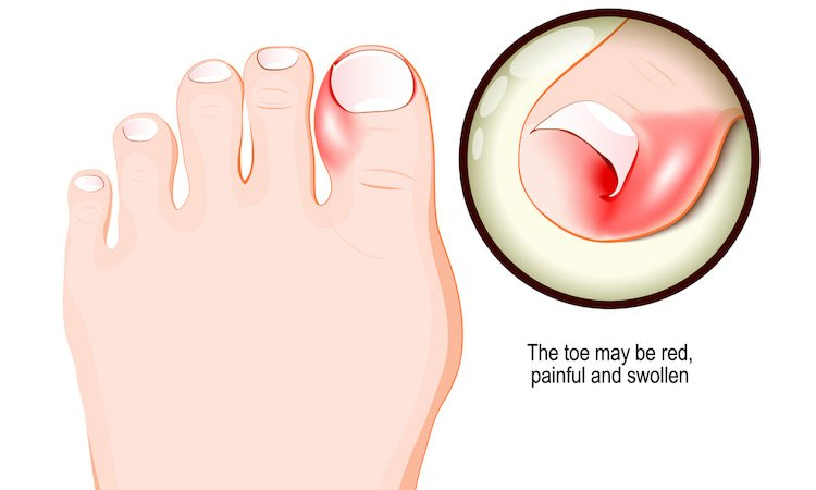 pain, greater risk, ingrown toenails