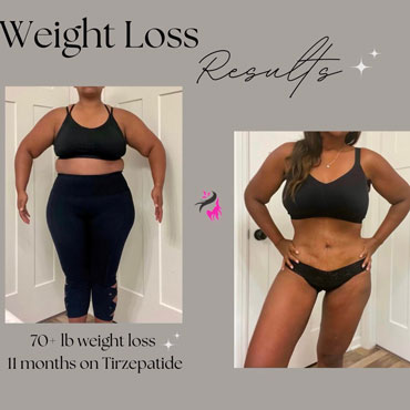 weight loss results tirzepatide