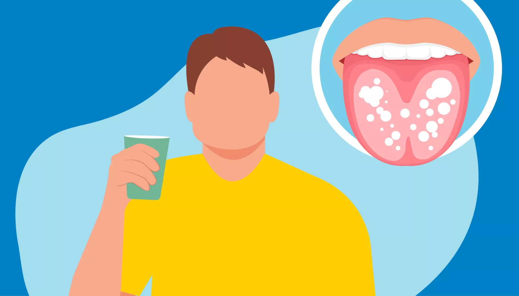 Mycostatin: Når Munnsoppen Trenger Et Tøft Motangrep 18 Illustrasjon av person med soppinfeksjon på tungen, synlig som hvite flekker, og et glass med væske i hånden . mycostatin mycostatin mikstur ie ml 100 000 ie mikstur suspensjon 100 ml nystatin bruk candida orifarm brukes munnen andre apotek amming informasjon lenge sopp virkestoff legemiddel norge