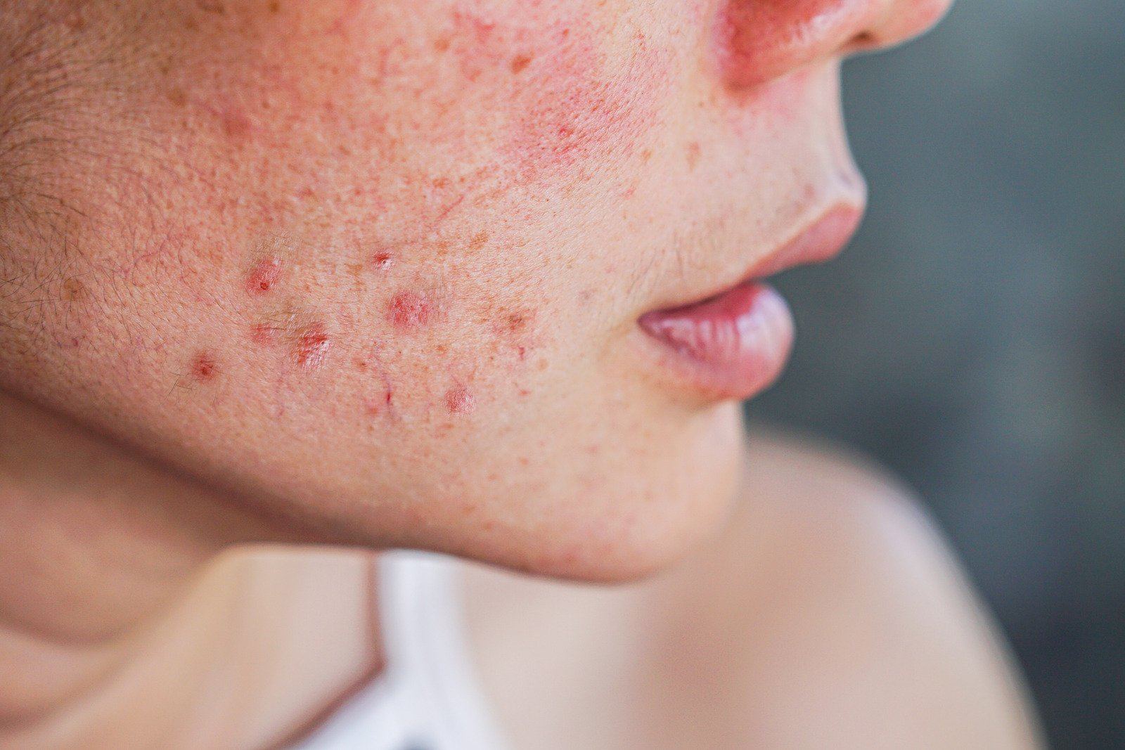 severe recalcitrant nodular acne