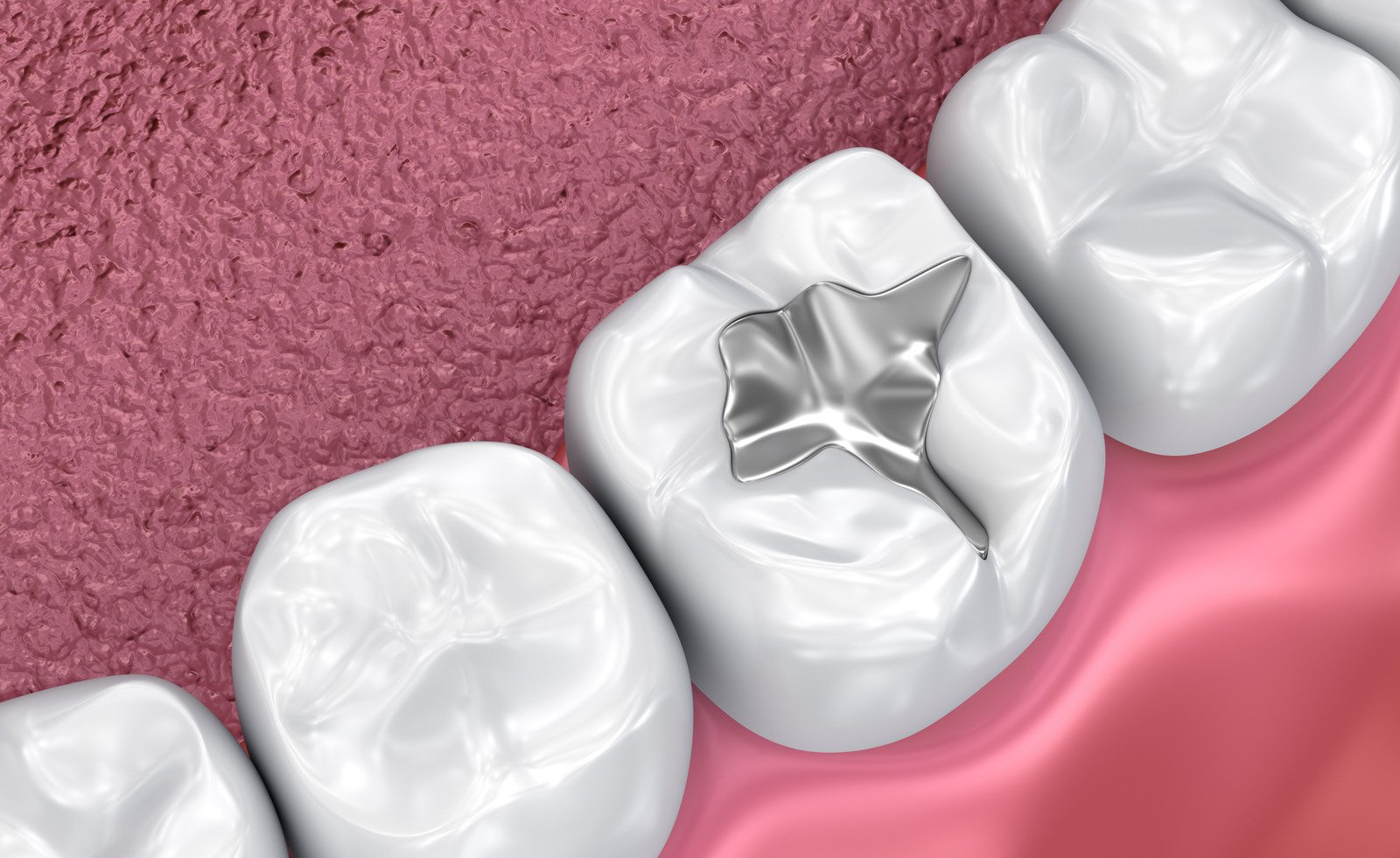 Dental amalgam fillings, inorganic mercury