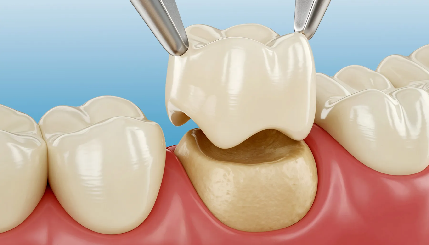 Tannkrone: Når tannen trenger ekstra styrke 9 Illustrasjon som viser tannkrone som plasseres på en slipt tann ved hjelp av dentalinstrumenter.