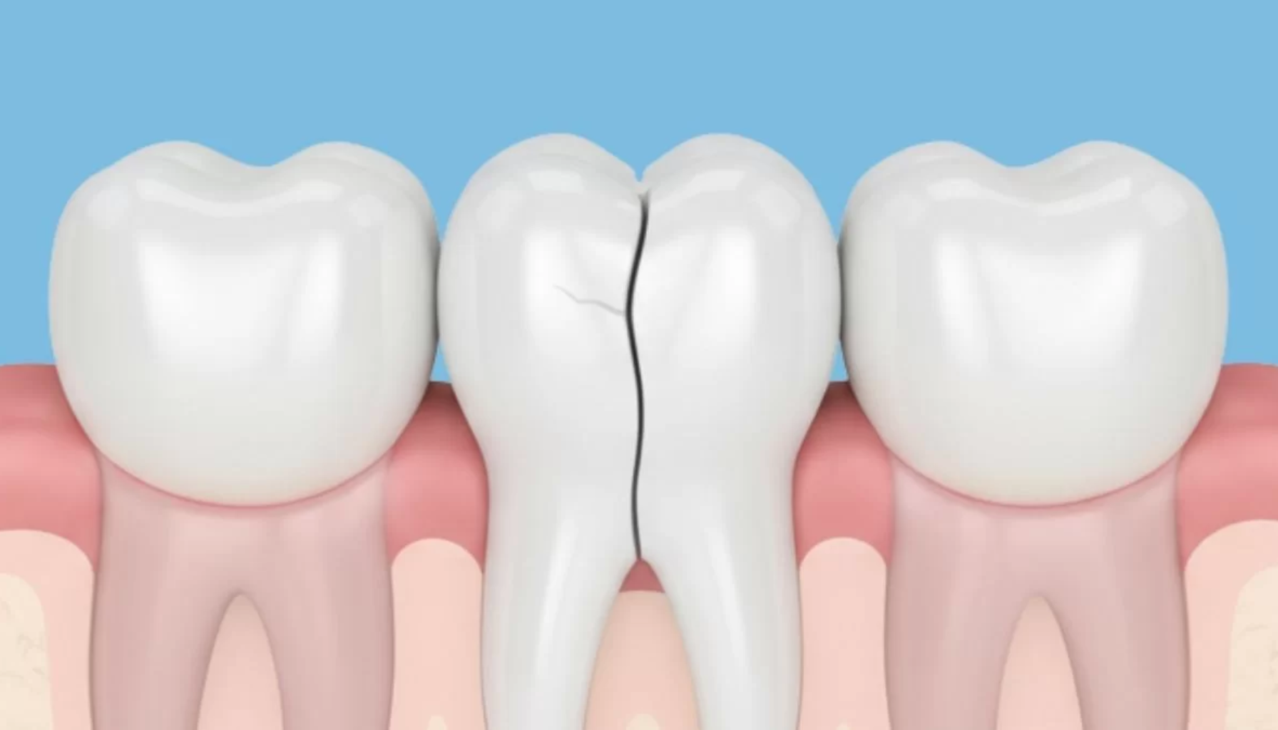 Sprekk i tann: Når du bør ta smerter på alvor 15 Illustrasjon av bakre jeksel med tydelig vertikal sprekk i tannen mellom to friske nabotenner.