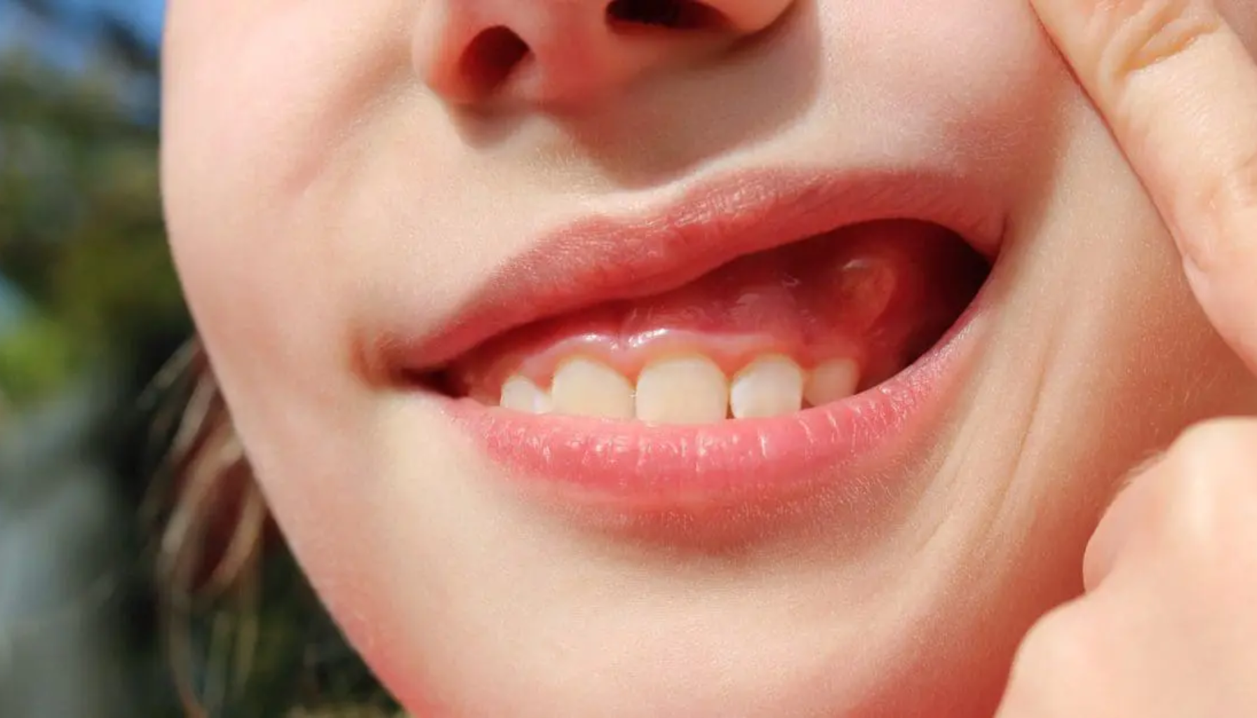 Fistel tannkjøtt: Når puss eller hevelse tyder på infeksjon 3 Barn trekker leppen opp for å vise rød og hoven kul på tannkjøttet som tyder på betennelse.