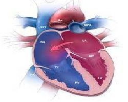  Common Congenital heart Defects