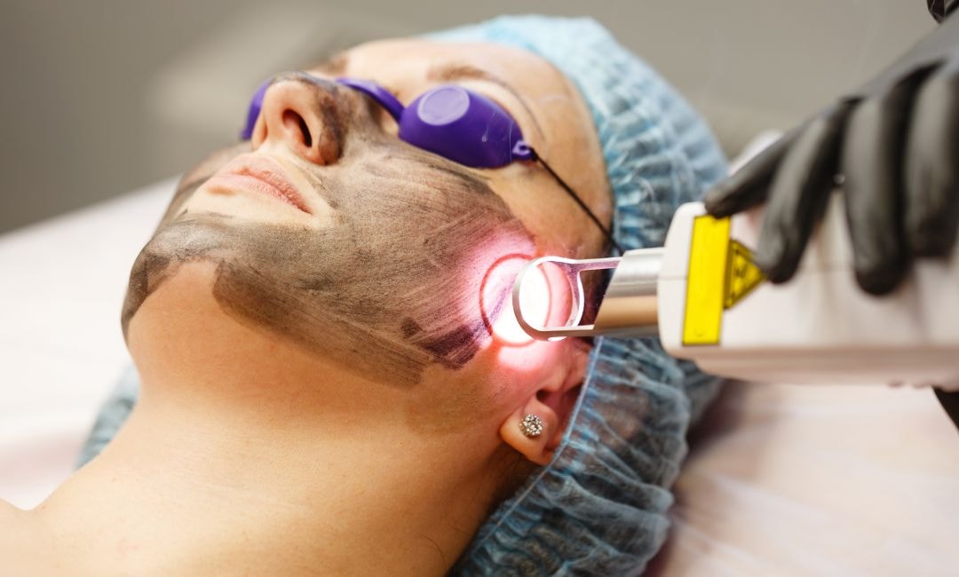 microneedling and laser resurfacing