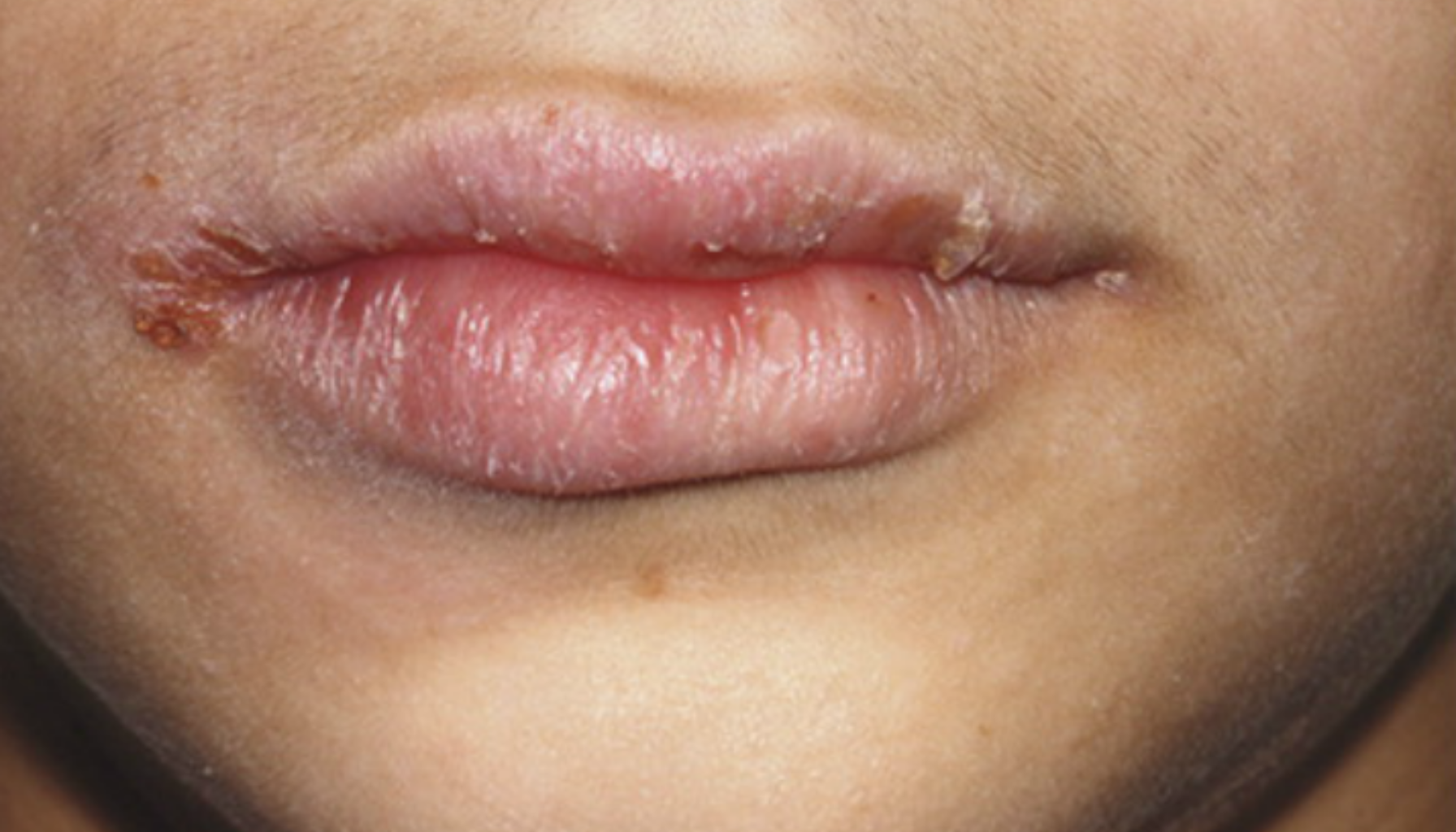 "Sår og skorper i munnviker med tørre, sprukne lepper."