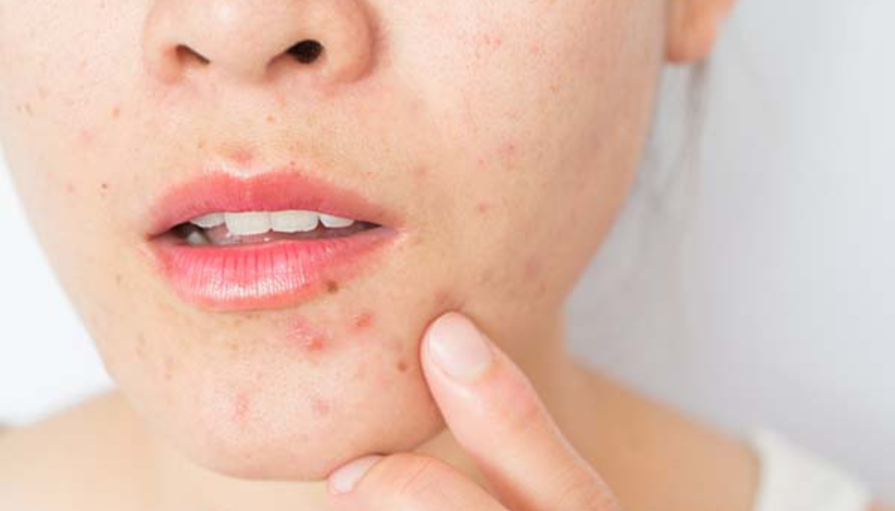 Kvinne med kviser og rødhet rundt munn og hake, peker på huden med finger, mulig tegn på akne eller hudirritasjon. periorificial dermatitt perioral dermatitt utslett rundt munnen rundt munnen behandling av perioral dermatitt årsaken til perioral dermatitt sammenheng med allergi dermatitt bruk av fete rundt øynene hos kvinner p piller rød hud 45 år behandling utslett bruk huden tilstanden utslettet hos ofte ansiktet kvinner unngå flere antibiotika bør kremer små uker behandlingen hudlege dersom kosmetikk krem utløsende forekommer faktorer hud øynene symptomer sone forverre vanligvis