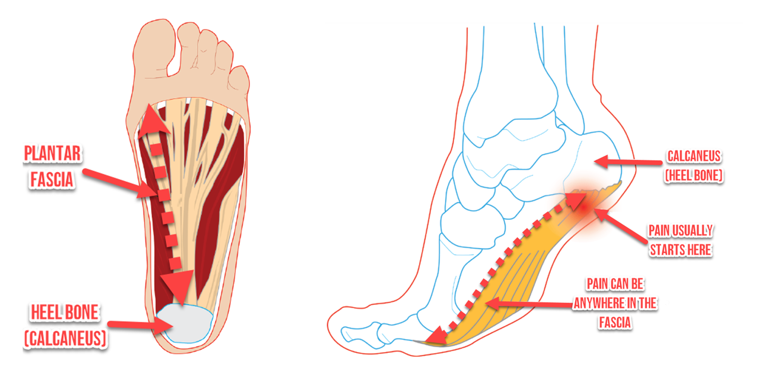 Why Do My Heels Hurt In The Morning Ergonx