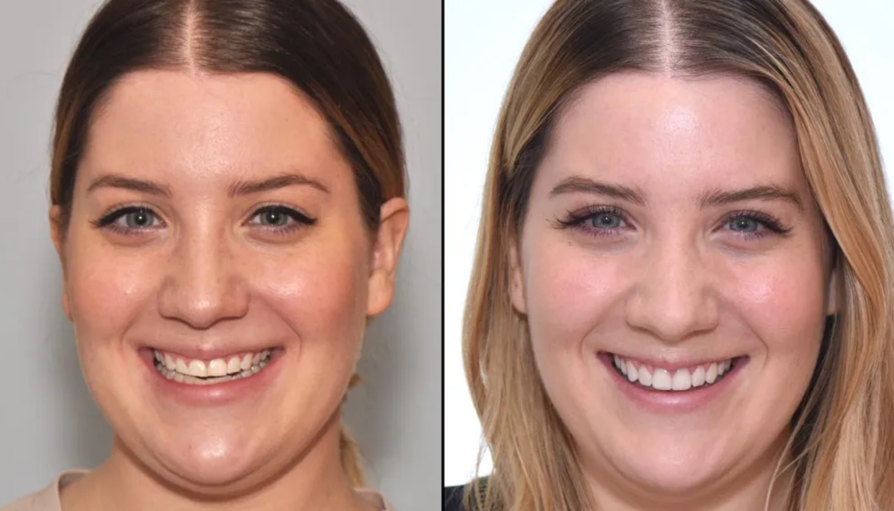 Falske tenner som ser ekte ut – Moderne løsninger for et naturlig smil 19 "Før og etter bilde av kvinne som viser tannregulering med tydelig forbedret smil og rette tenner."