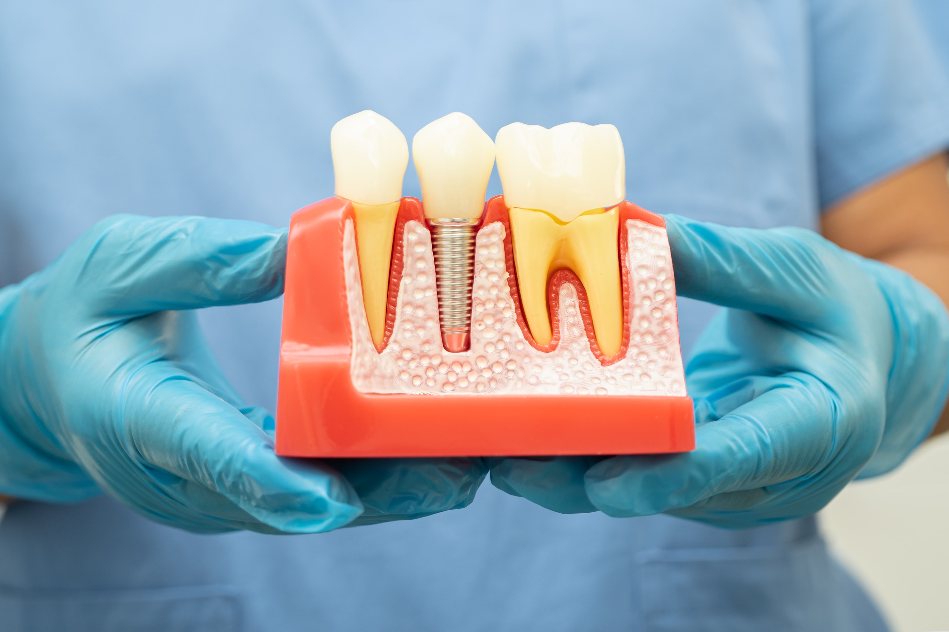 oral surgeon holding a dental model of a dental implant