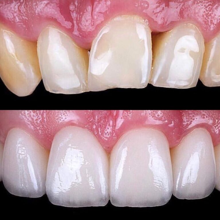 lithium disilicate crowns look natural and may even look better than your own teeth