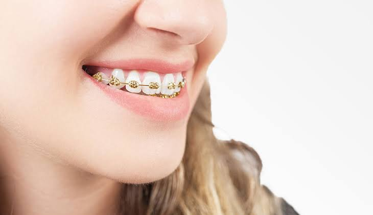 gold braces, align teeth
